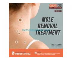 best Advanced Mole Treatment In bangalore
